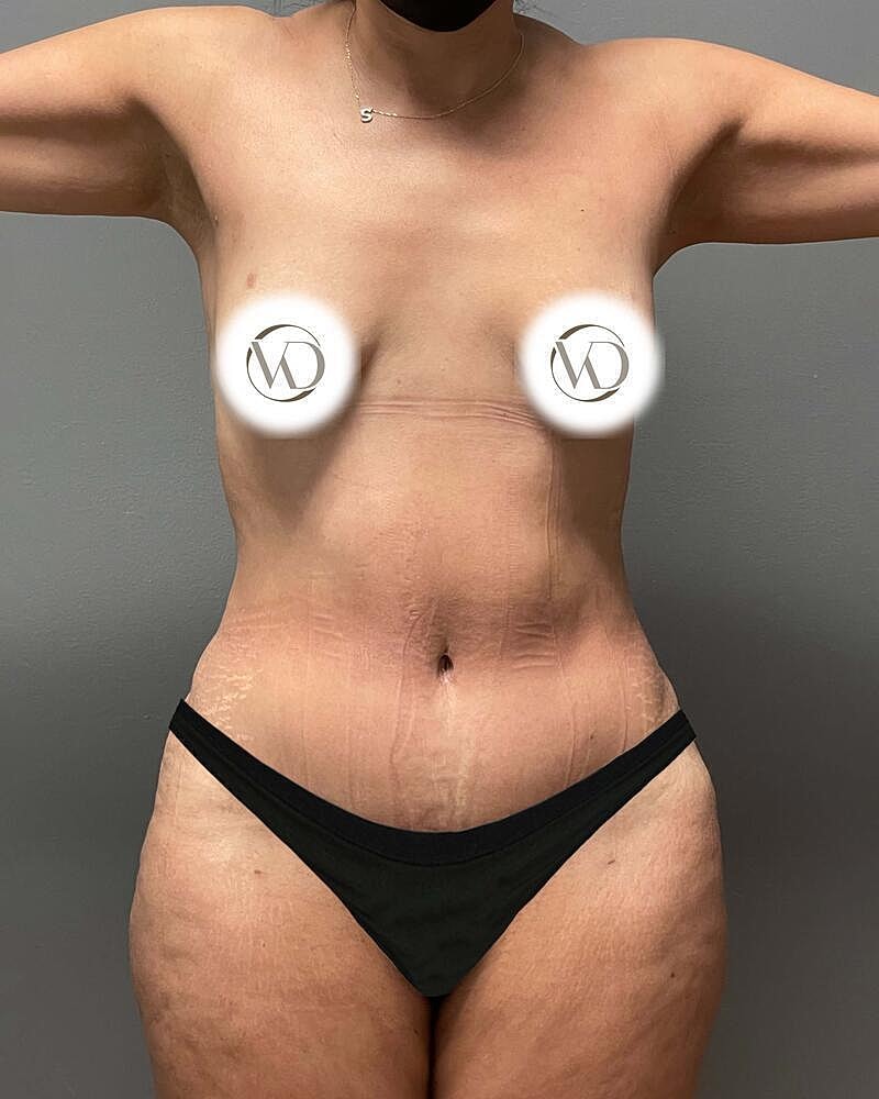 Tummy Tuck Before & After