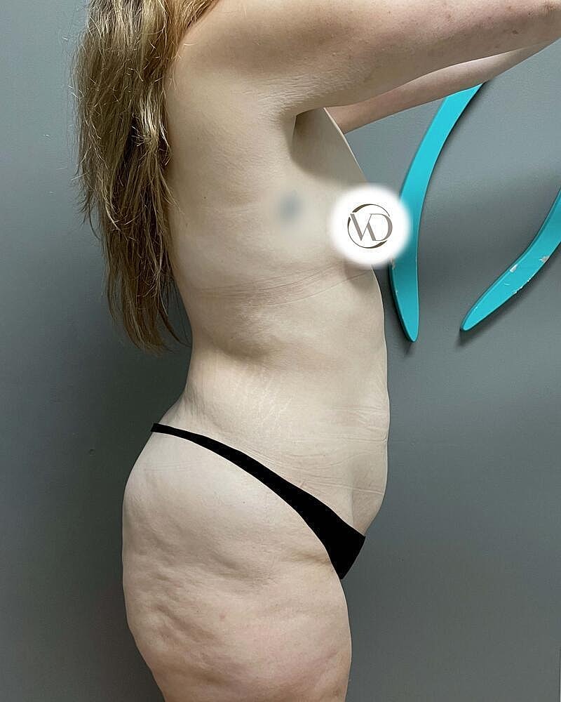 Tummy Tuck Before & After