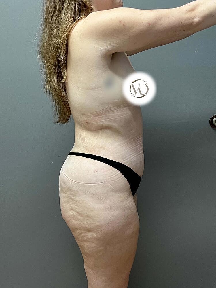 Tummy Tuck Before & After