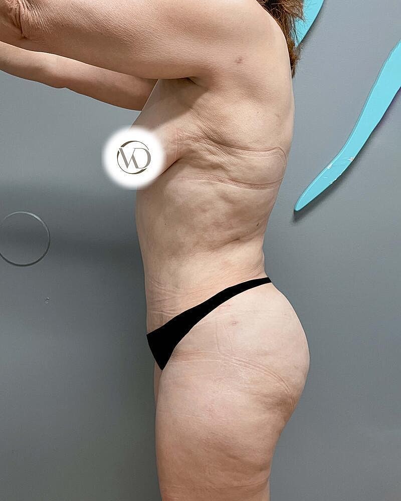 Tummy Tuck Before & After