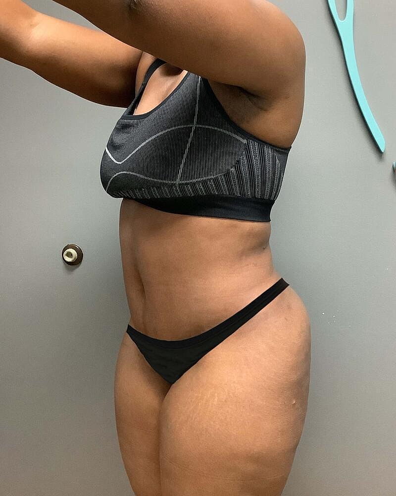 Tummy Tuck Before & After