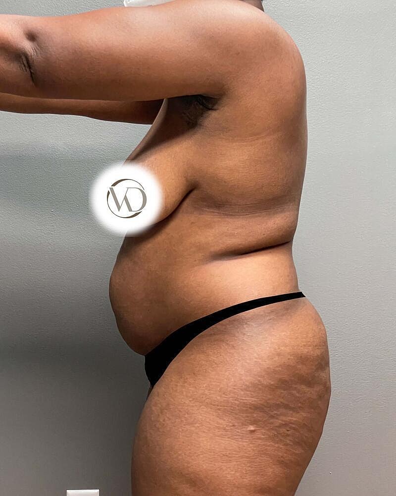 Tummy Tuck Before & After
