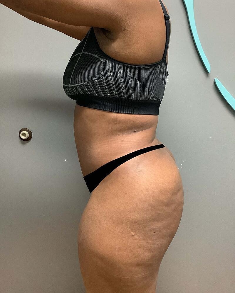 Tummy Tuck Before & After