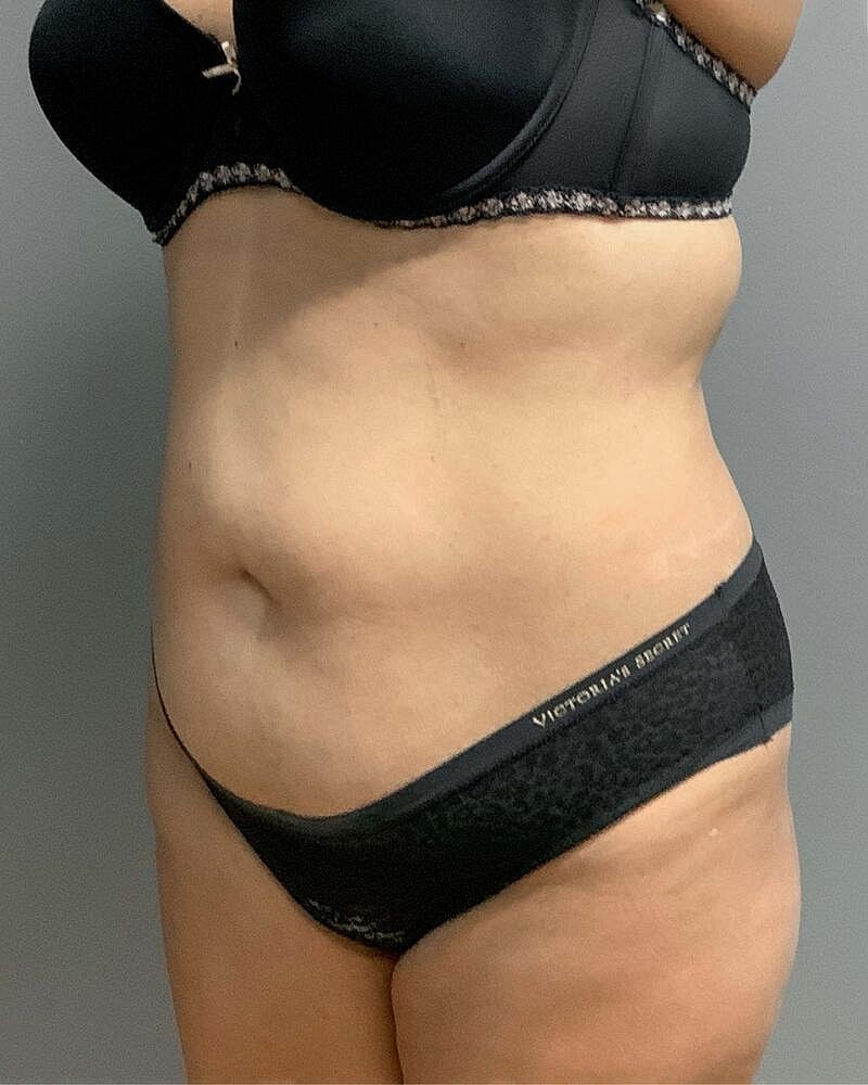 Tummy Tuck Before & After