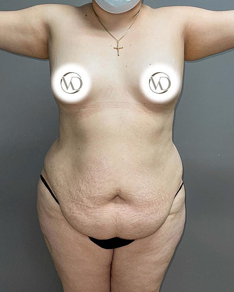 Tummy Tuck Before & After