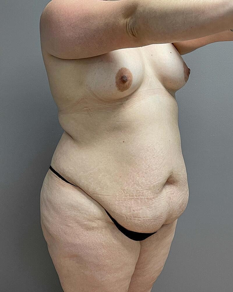Tummy Tuck Before & After