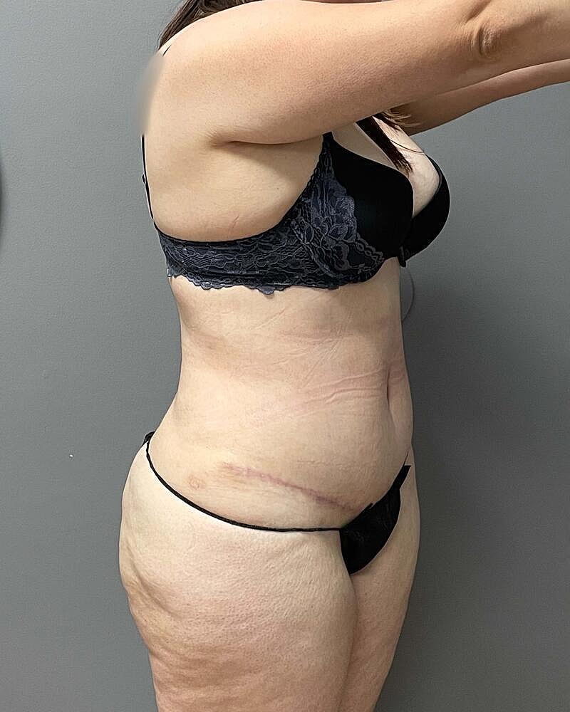 Tummy Tuck Before & After