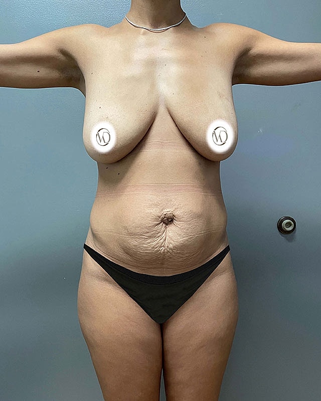 Tummy Tuck Before & After