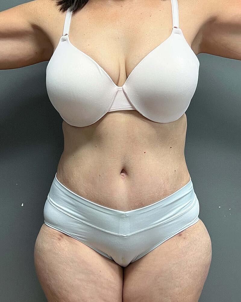 Tummy Tuck Before & After