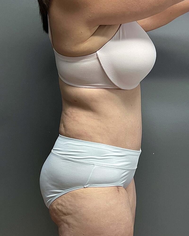 Tummy Tuck Before & After