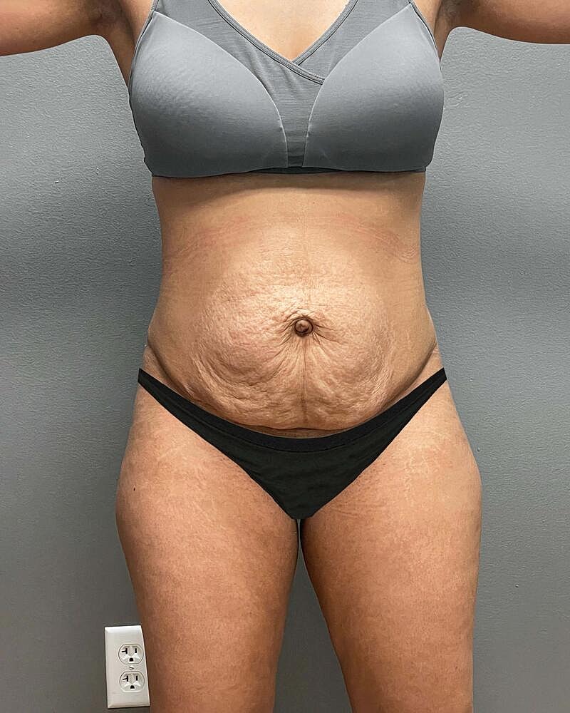 Tummy Tuck Before & After