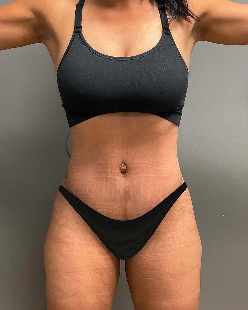 Tummy Tuck Before & After
