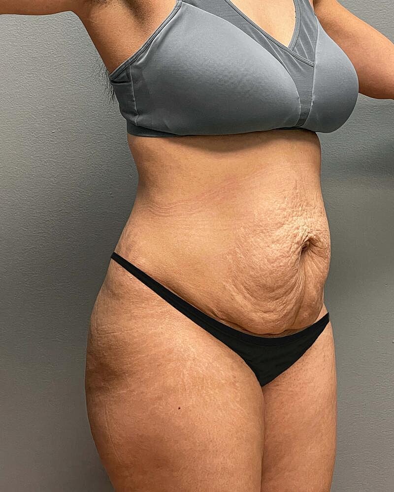 Tummy Tuck Before & After