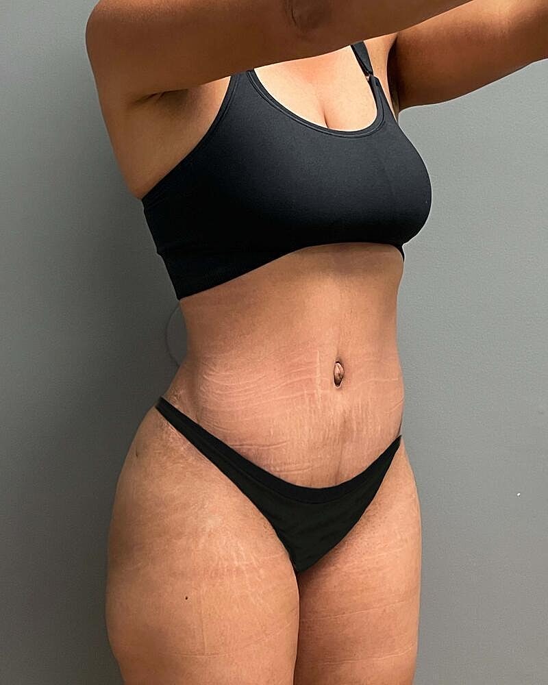 Tummy Tuck Before & After