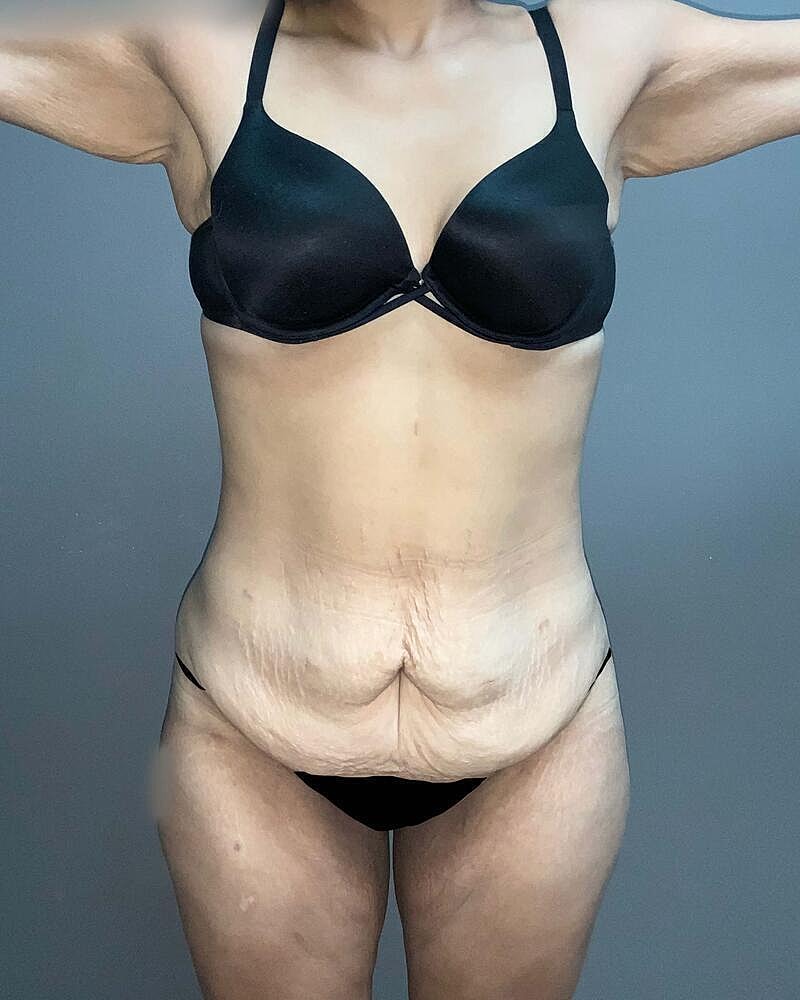 Tummy Tuck Before & After