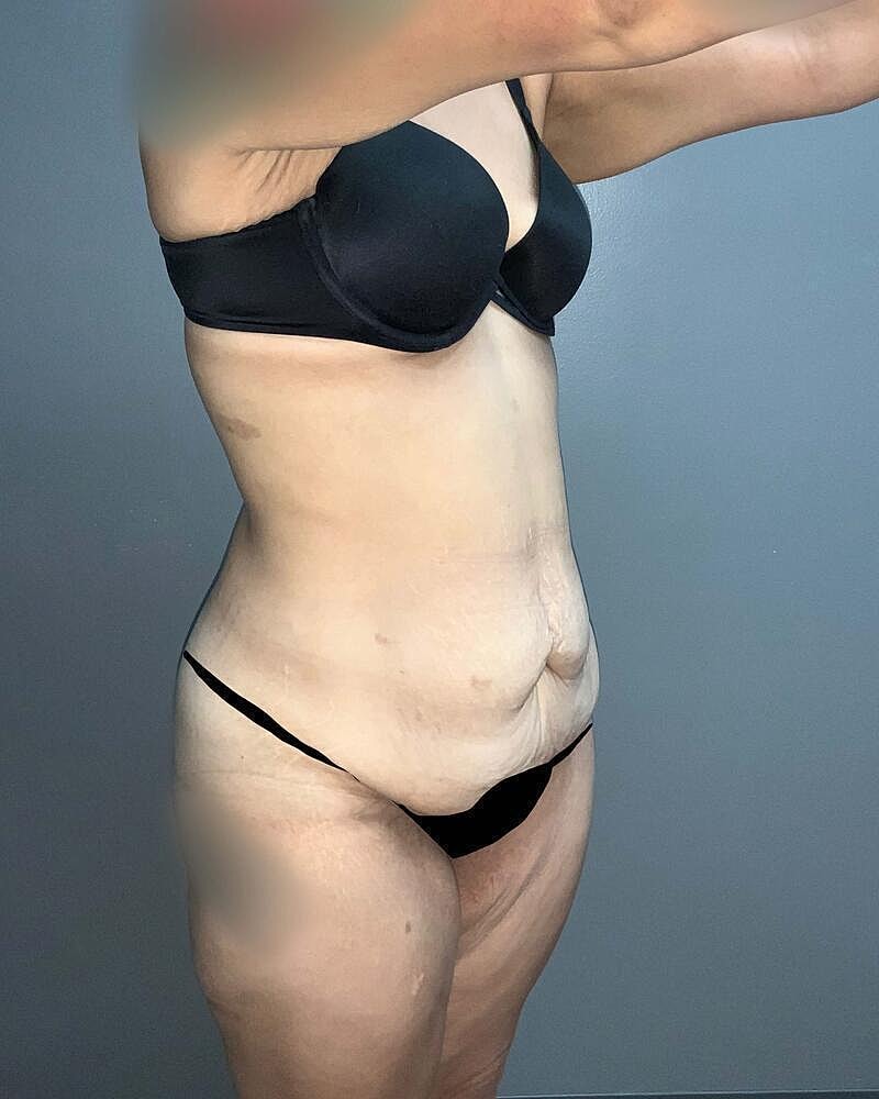 Tummy Tuck Before & After