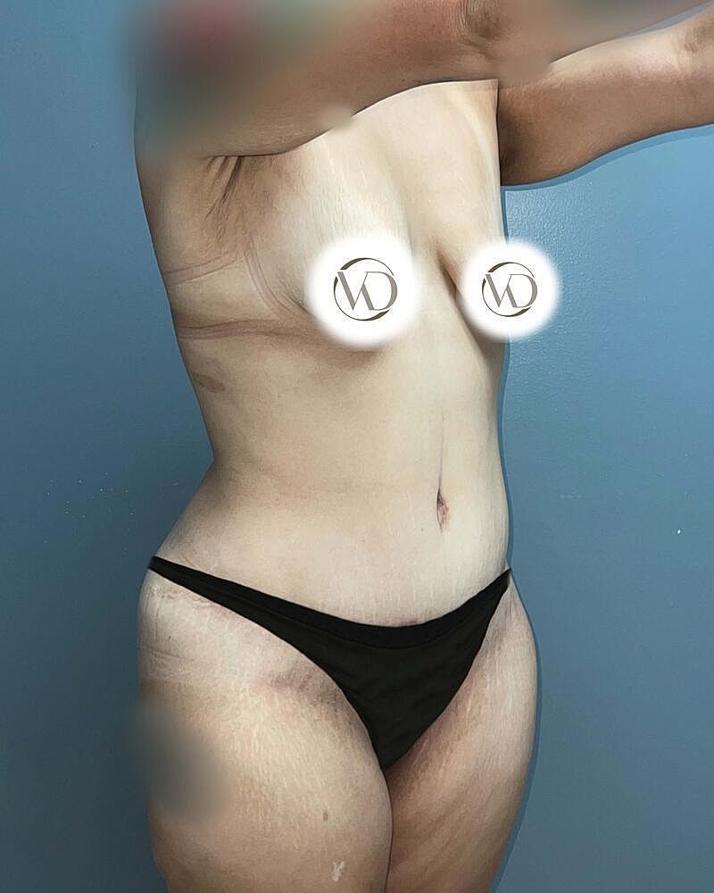 Tummy Tuck Before & After