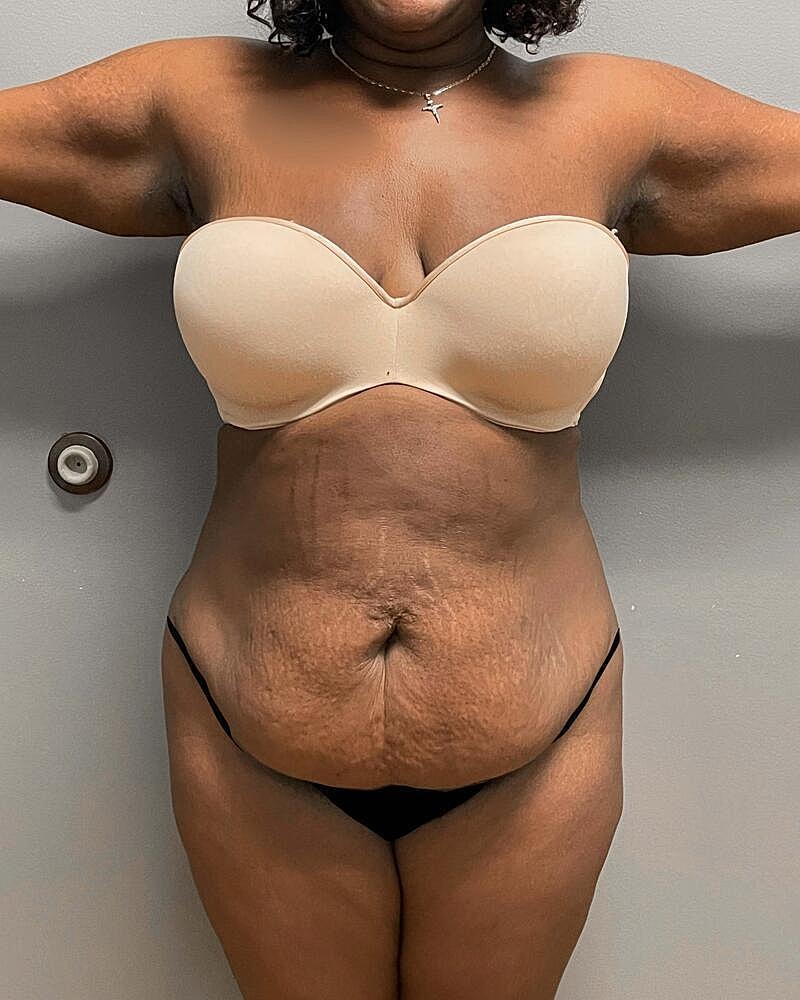 Tummy Tuck Before & After