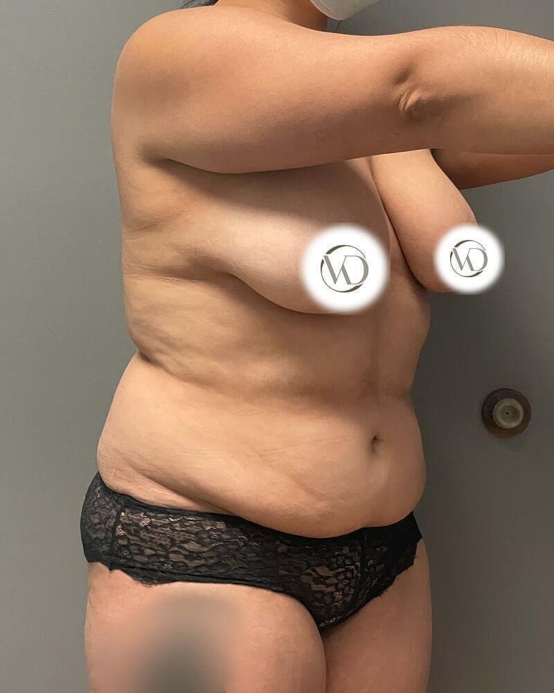 Tummy Tuck Before & After