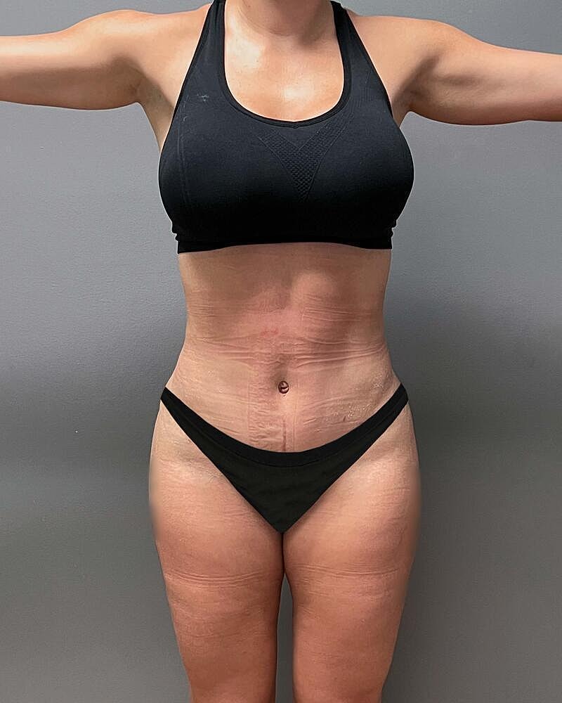 Tummy Tuck Before & After