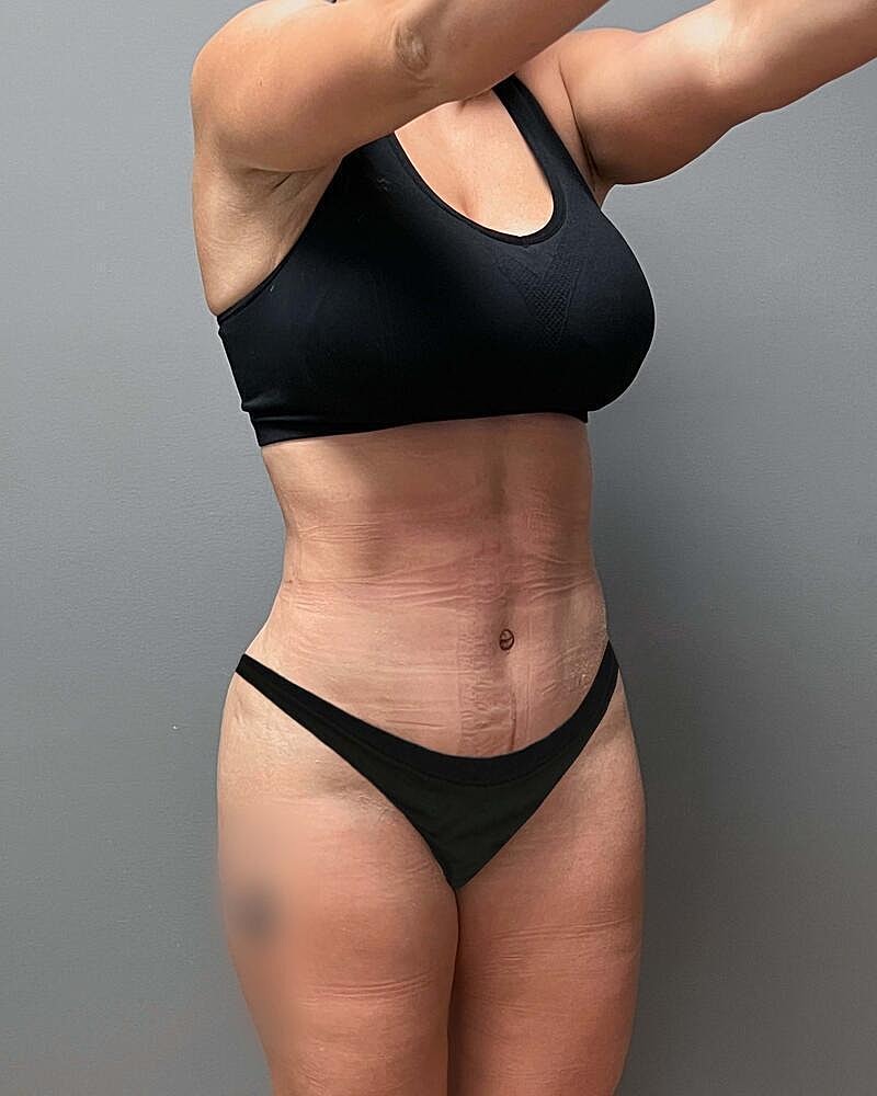 Tummy Tuck Before & After