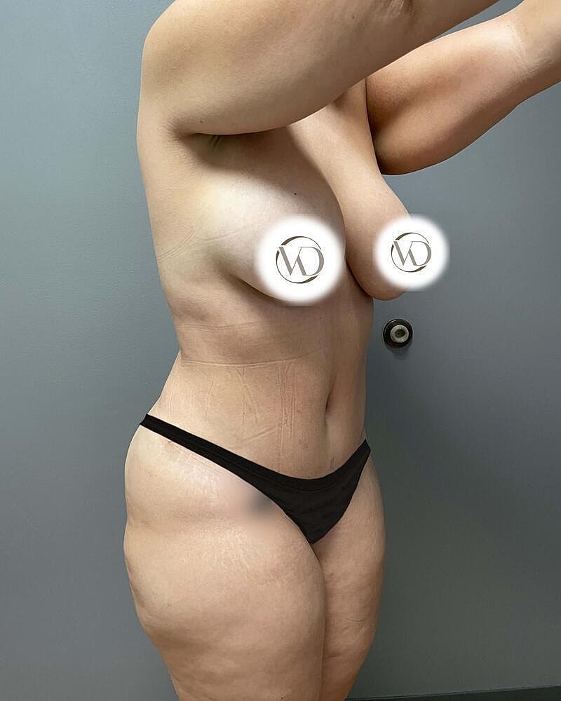 Tummy Tuck Before & After
