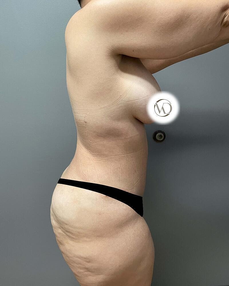 Tummy Tuck Before & After