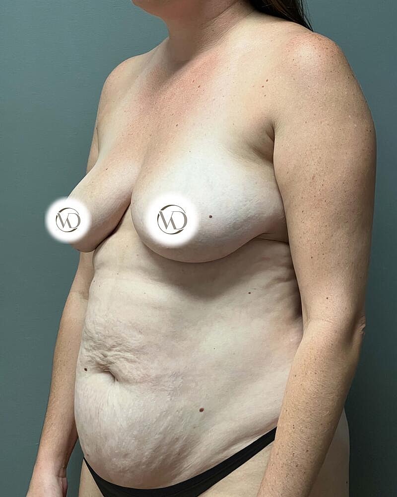 Tummy Tuck Before & After