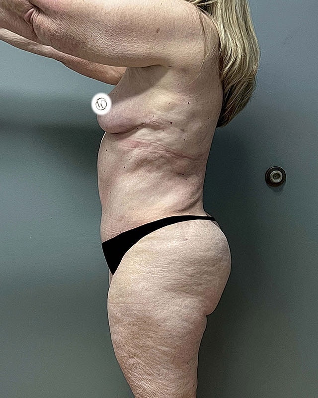 Tummy Tuck Before & After