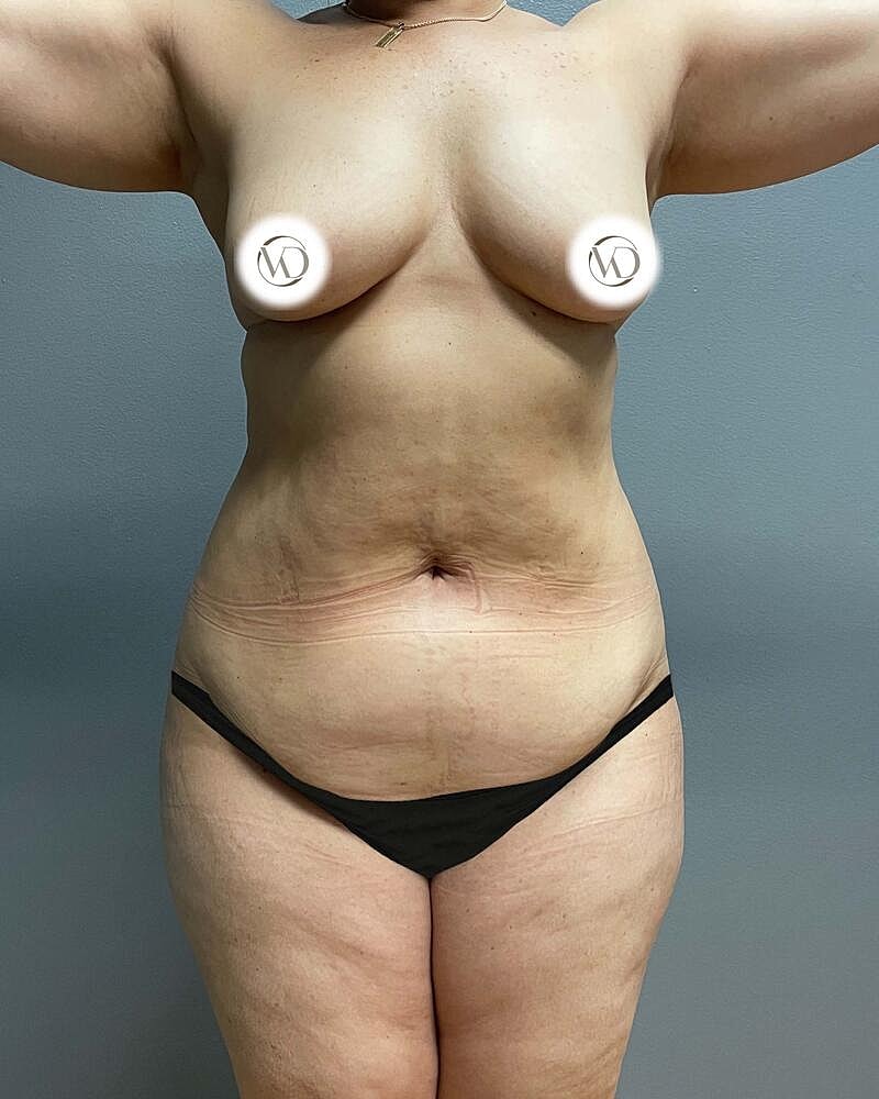 Tummy Tuck Before & After