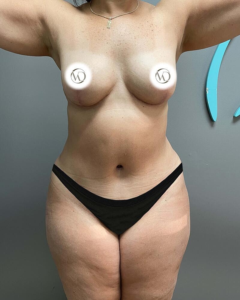 Tummy Tuck Before & After