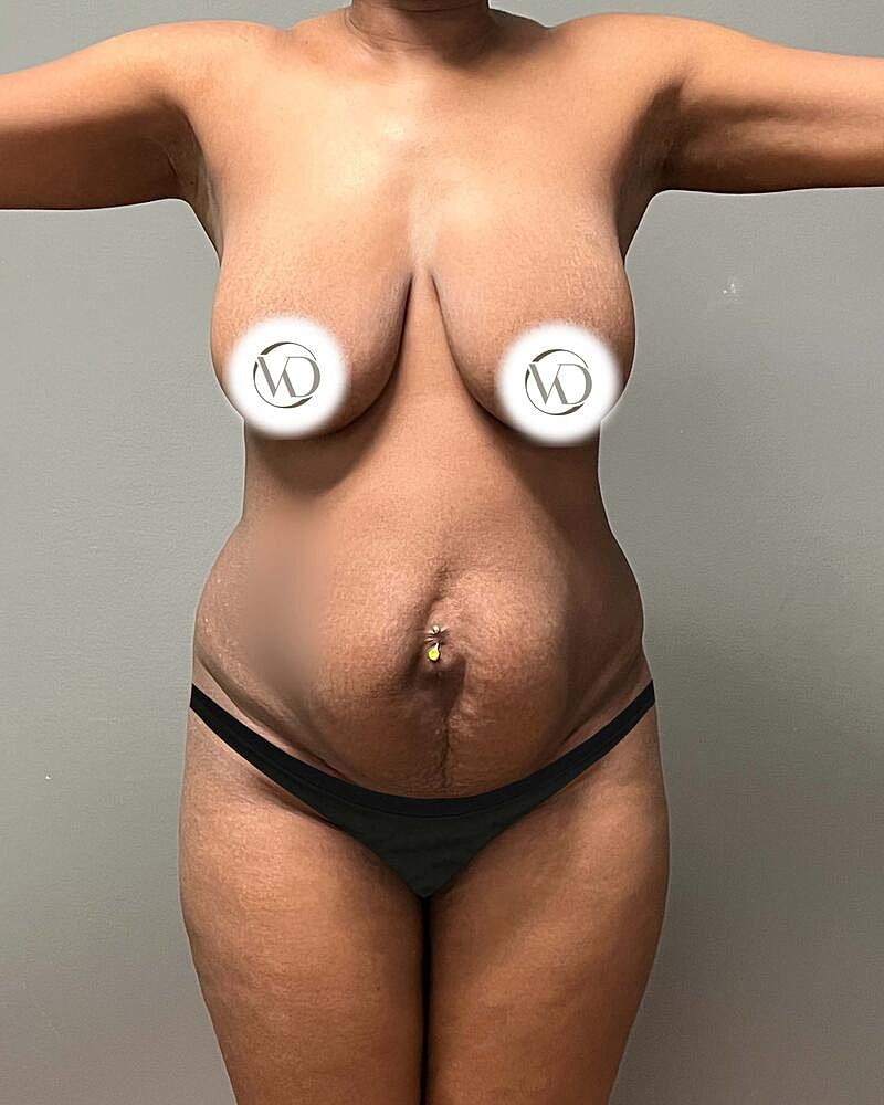 Tummy Tuck Before & After