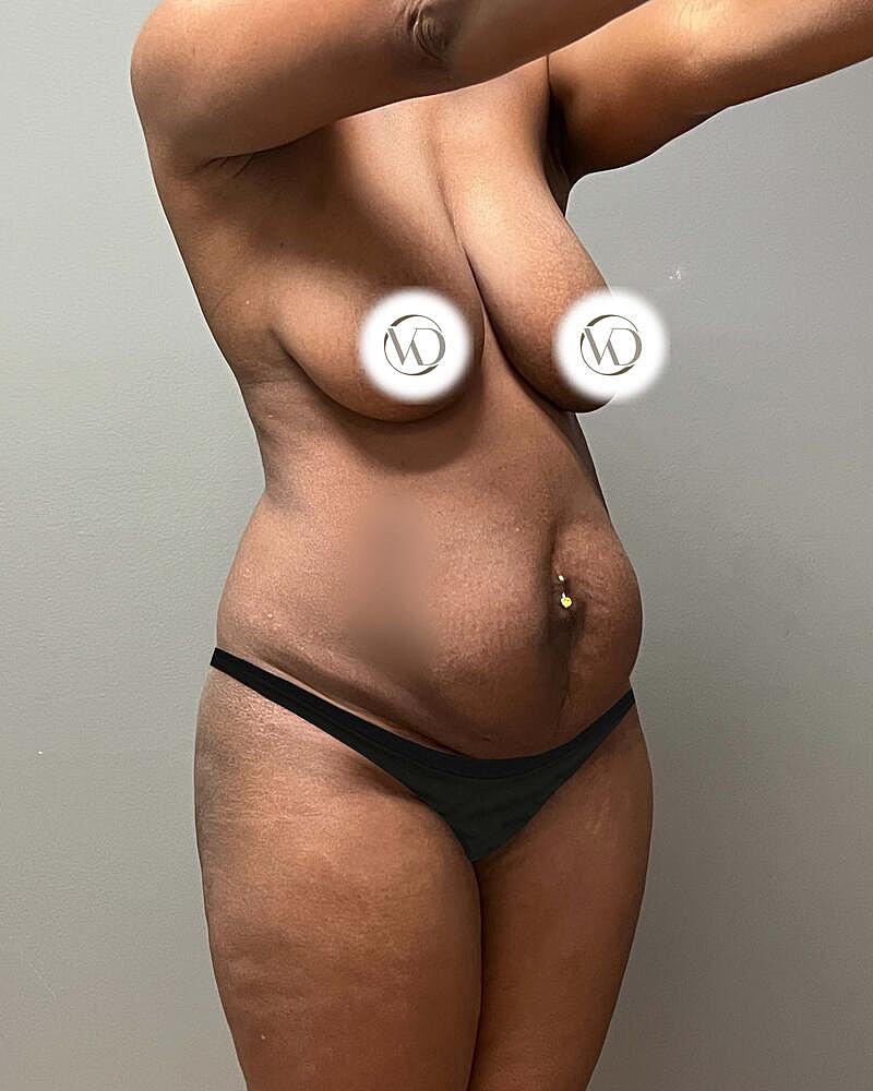 Tummy Tuck Before & After