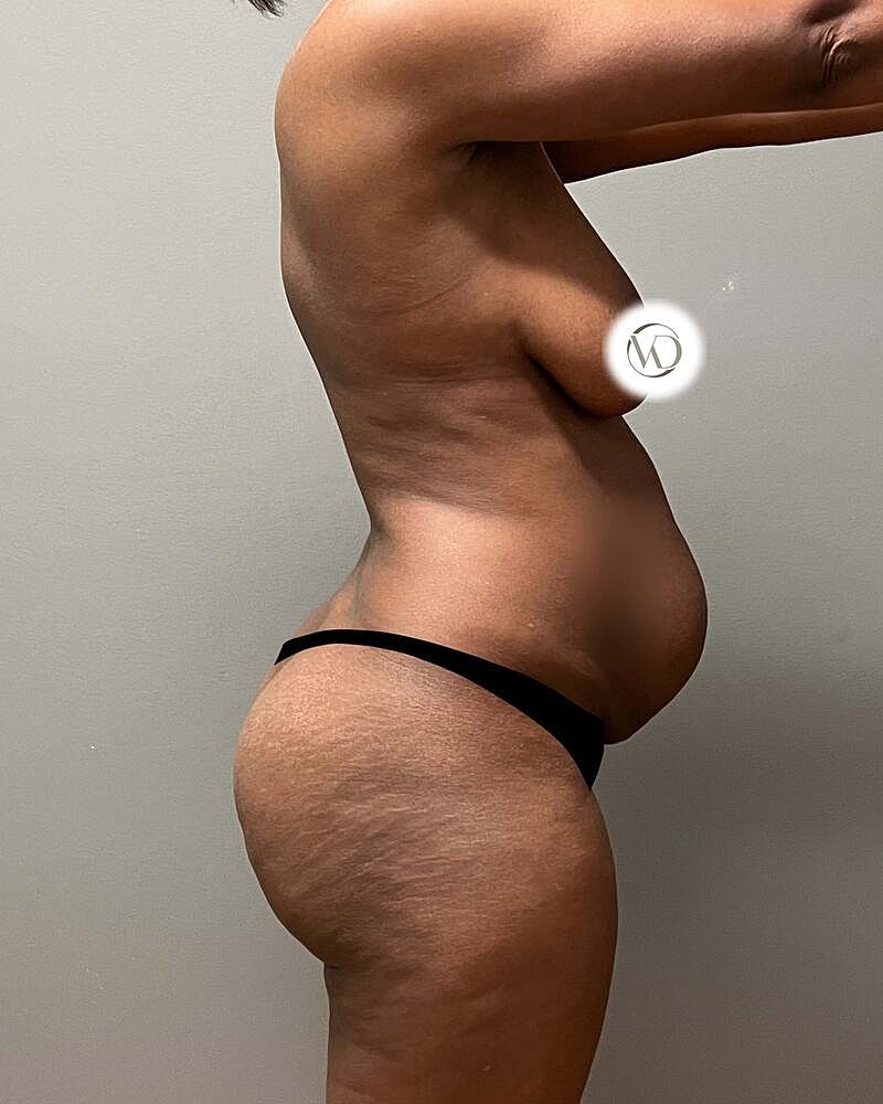 Tummy Tuck Before & After