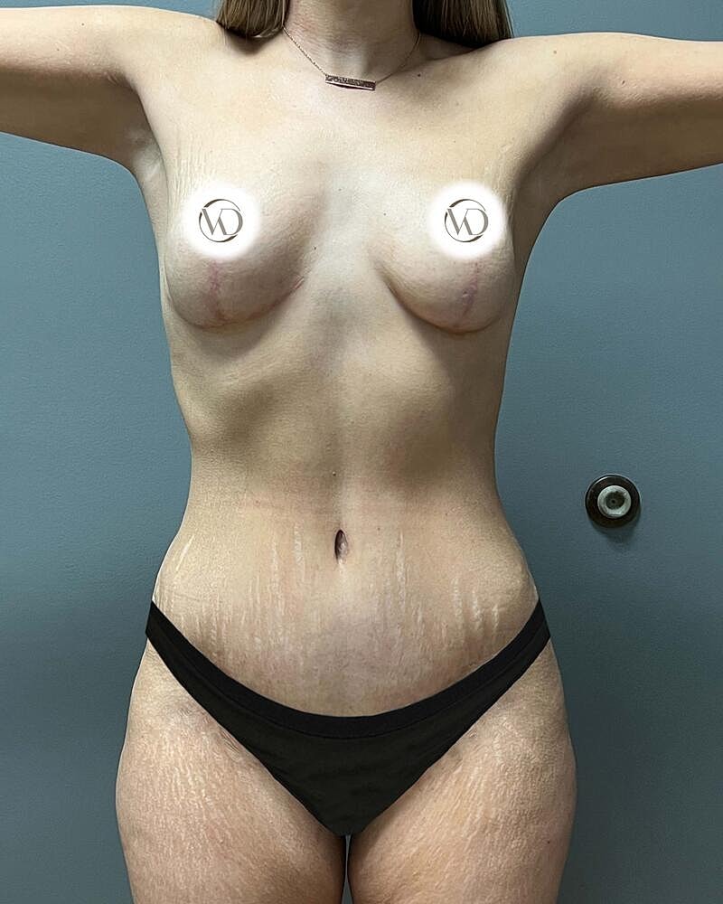 Tummy Tuck Before & After