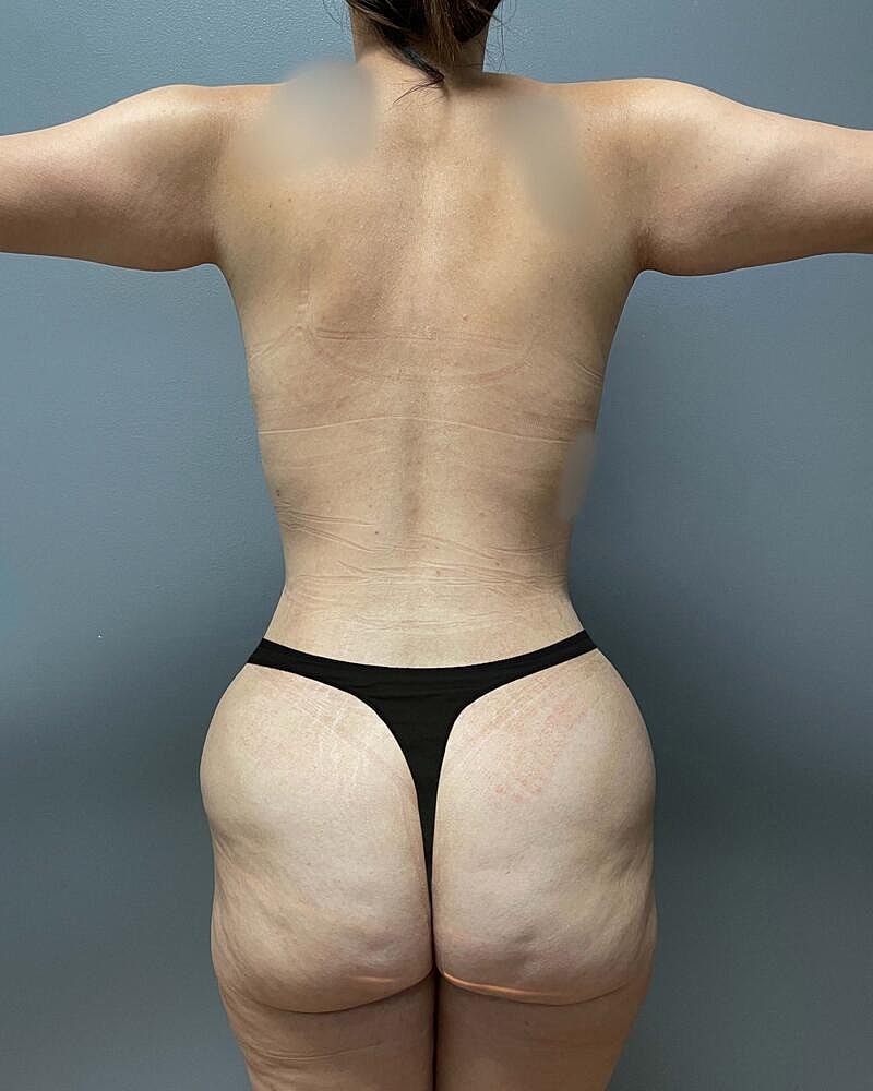 Tummy Tuck Before & After