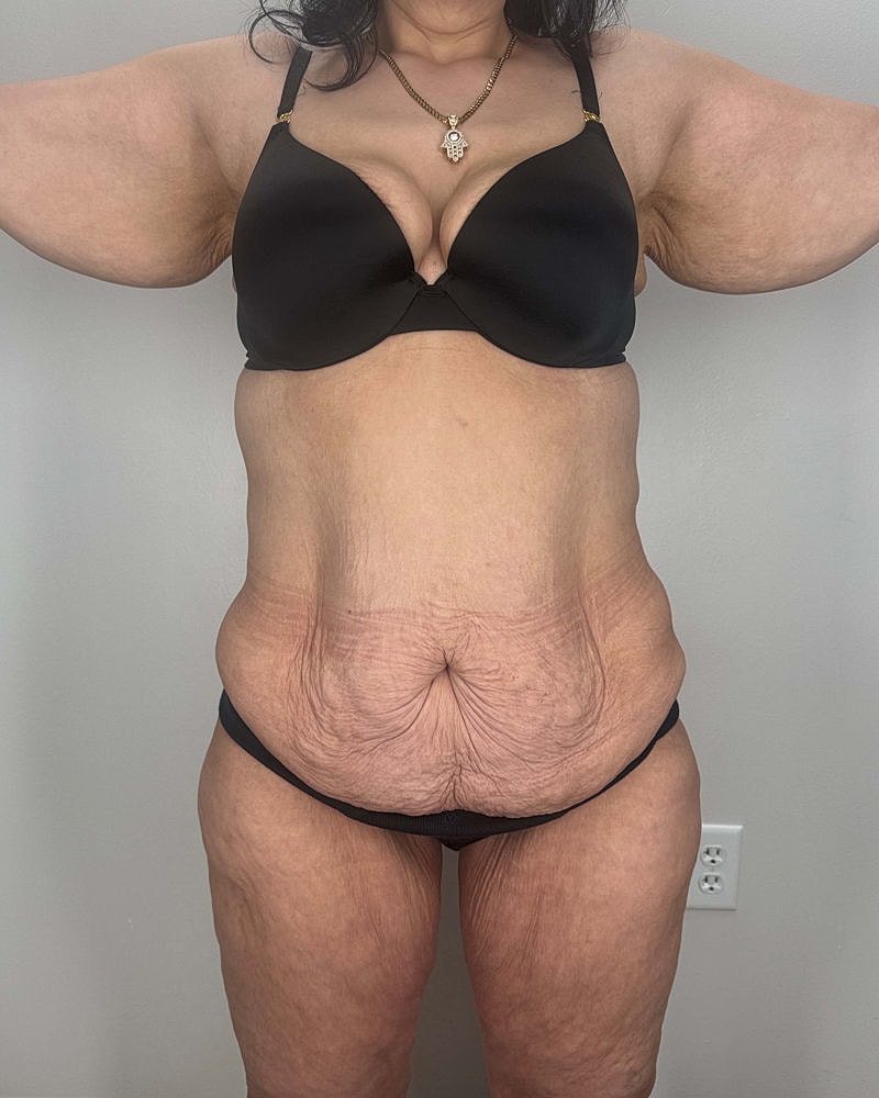 Tummy Tuck Before & After
