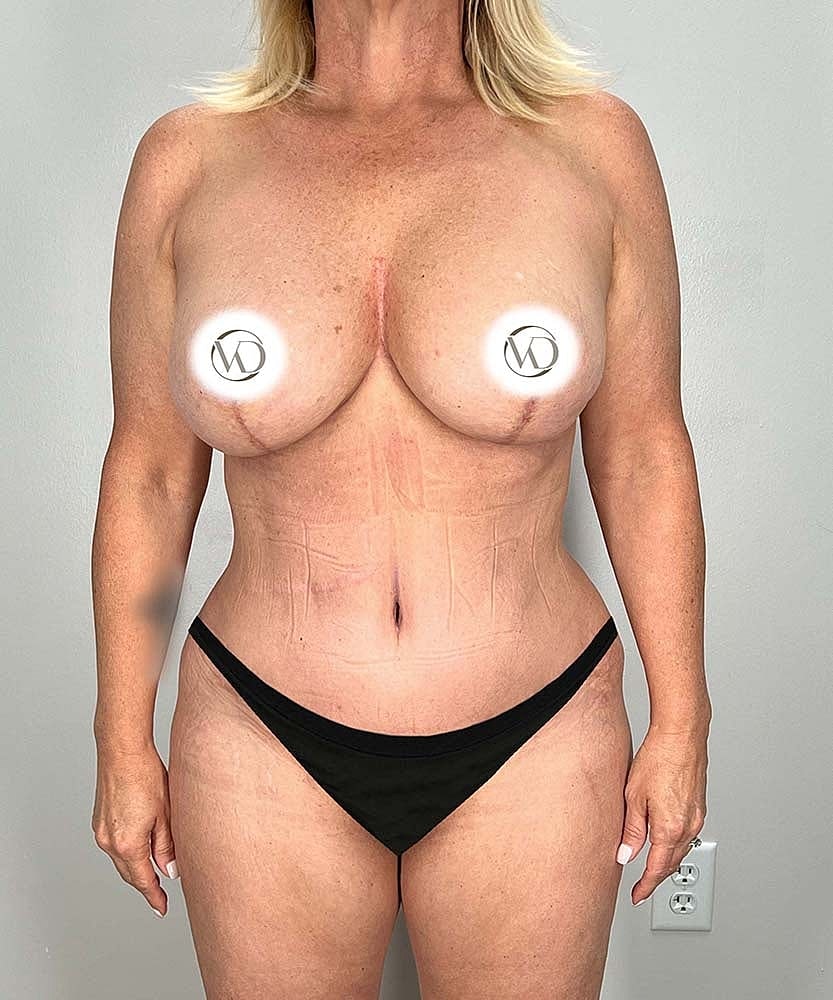 Tummy Tuck Before & After