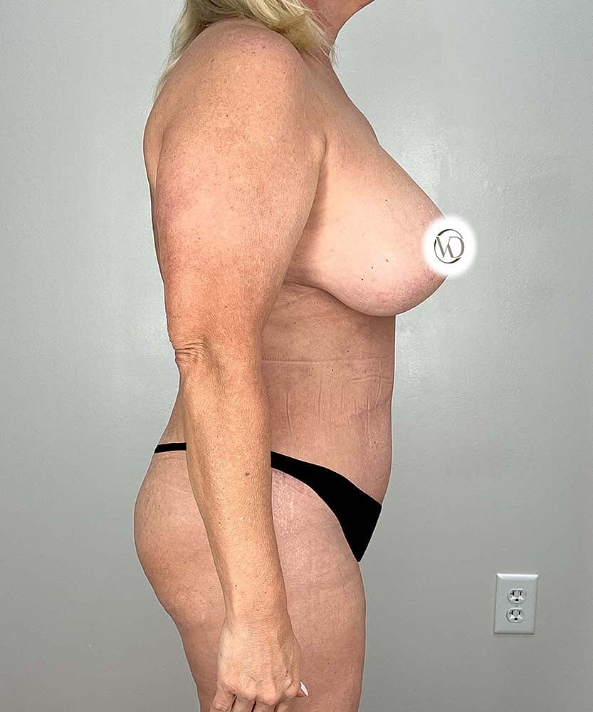Tummy Tuck Before & After