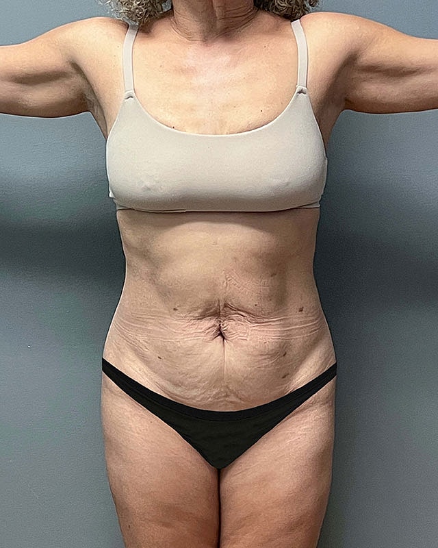 Tummy Tuck Before & After