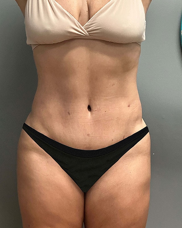 Tummy Tuck Before & After