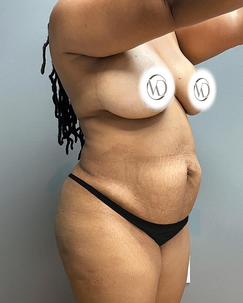 Tummy Tuck Before & After