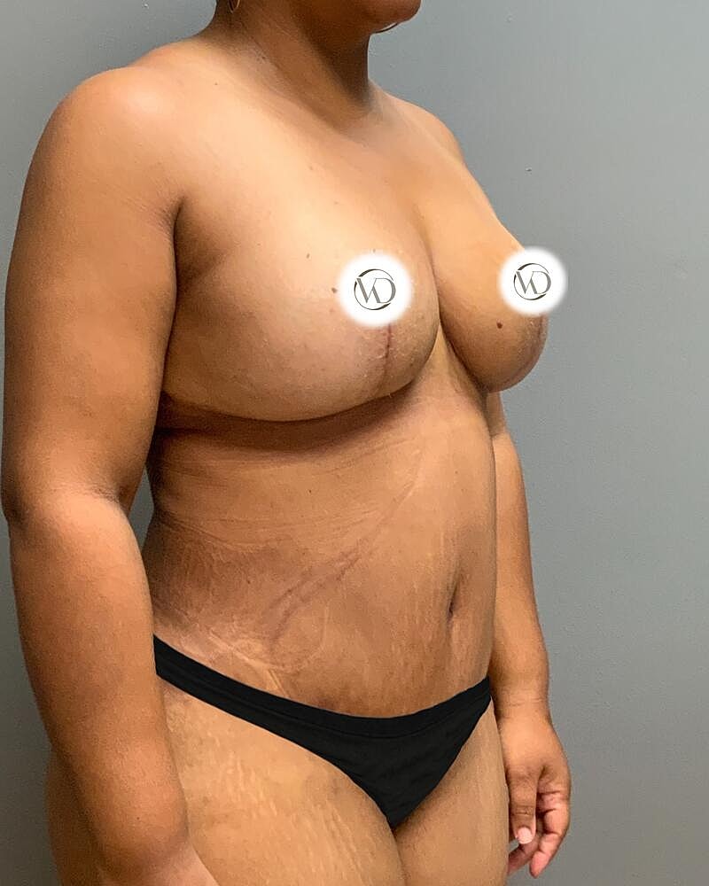 Tummy Tuck Before & After