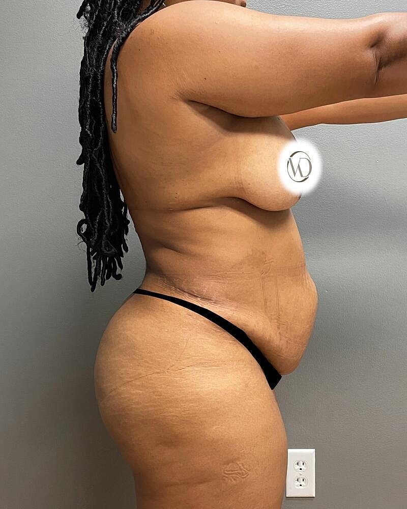 Tummy Tuck Before & After