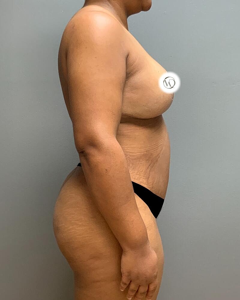 Tummy Tuck Before & After