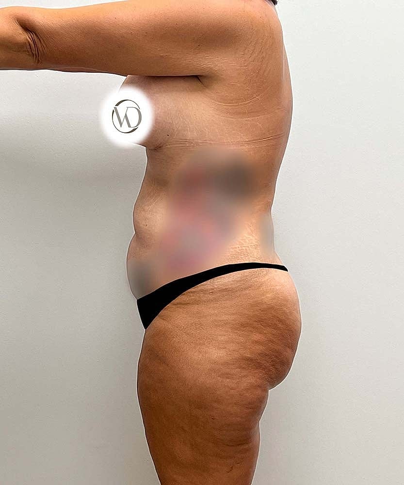 Tummy Tuck Before & After