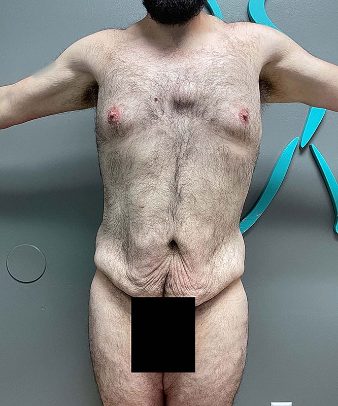 Tummy Tuck Before & After