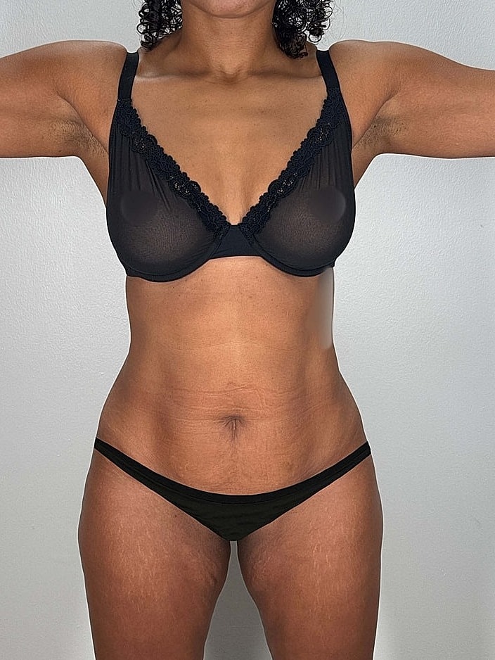 Tummy Tuck Gallery Before & After