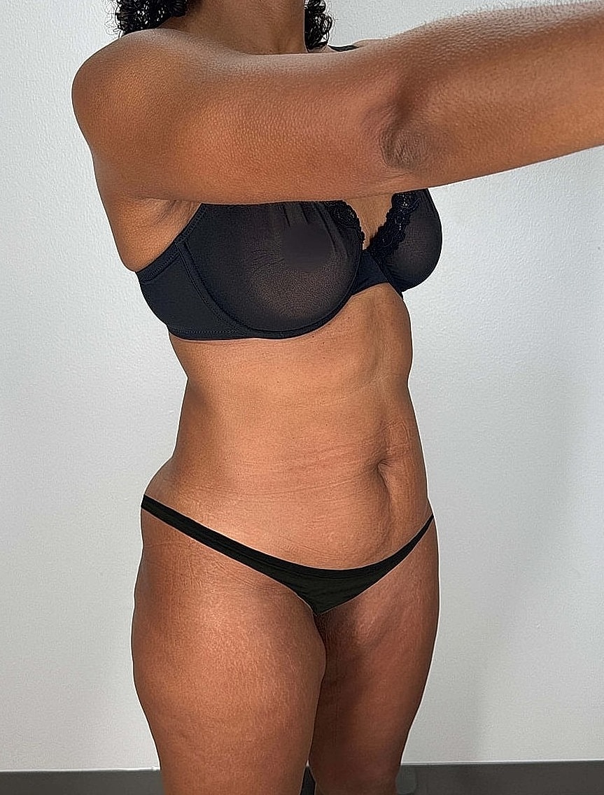 Tummy Tuck Gallery Before & After