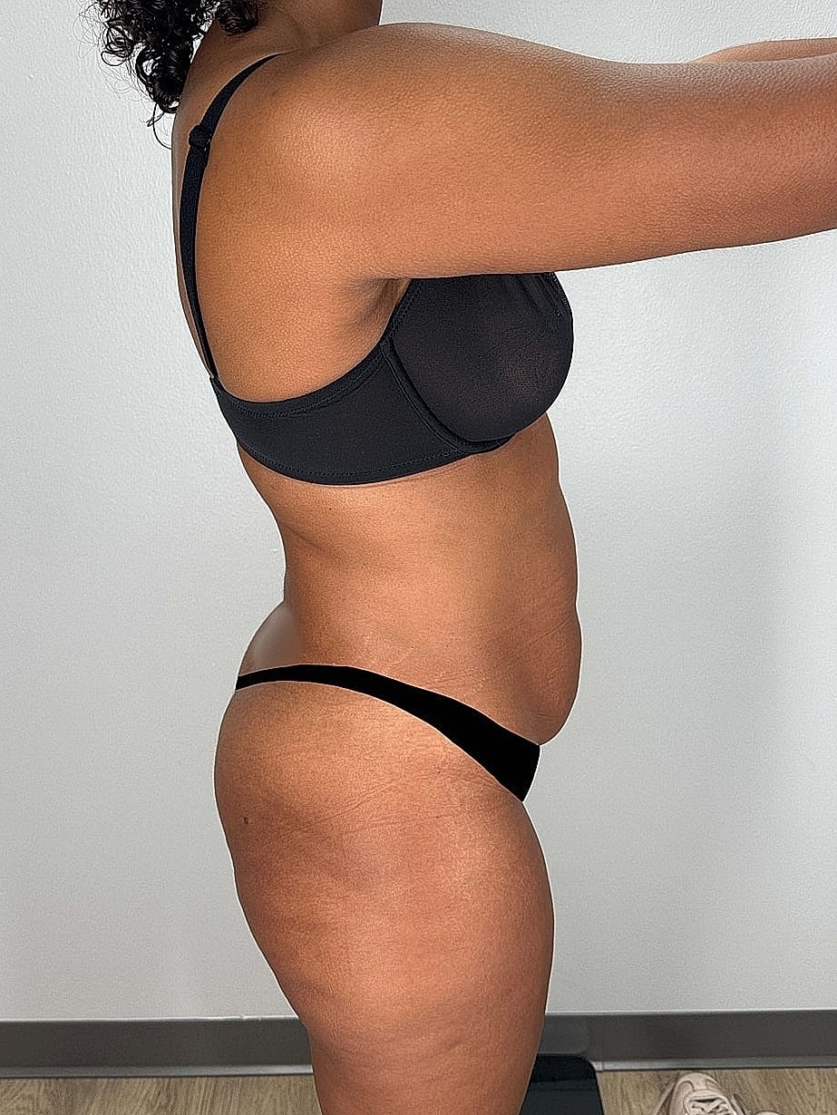 Tummy Tuck Gallery Before & After
